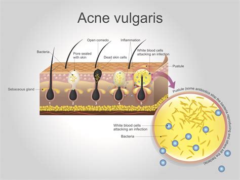 What is Acne Vulgaris?