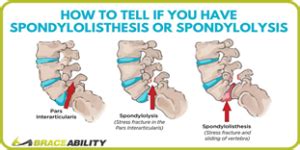 Spondylosis, Spondylolysis, and Spondylolisthesis: What’s the difference?