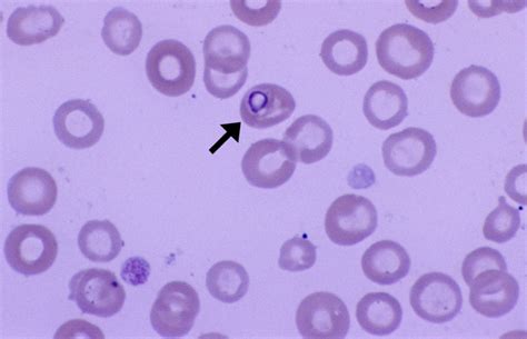 Babesia – Cells and Smears