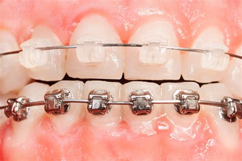 Why Clear Braces are Better Than Traditional Metal Braces? | Guide