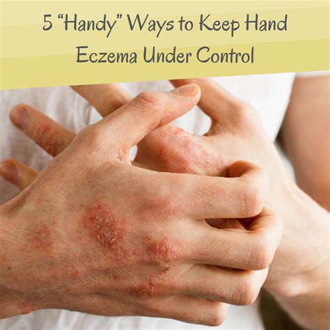 5 “Handy” Ways to Keep Hand Eczema Under Control | Eczema, Eczema ...