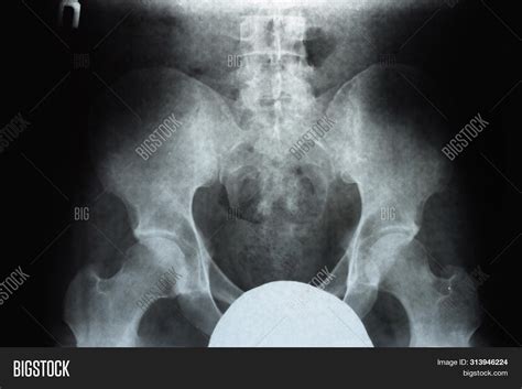 X-ray Pelvis Sacrum. X Image & Photo (Free Trial) | Bigstock