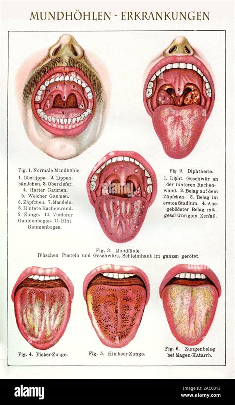 Tongue Bumps