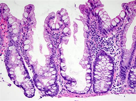 Sessile Serrated Adenoma Histology