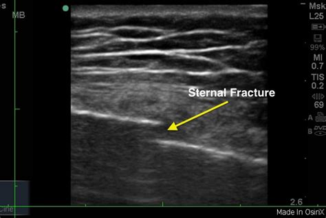 Sternal Fracture | Emory School of Medicine