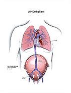 Air Embolism Medical Illustration Medivisuals