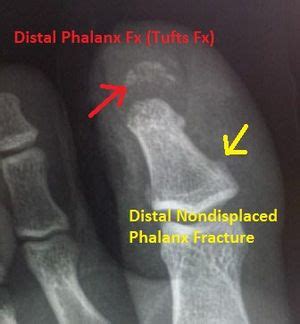 Distal phalanx (finger) fracture - WikEM