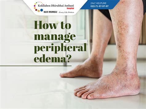 How to manage peripheral edema?