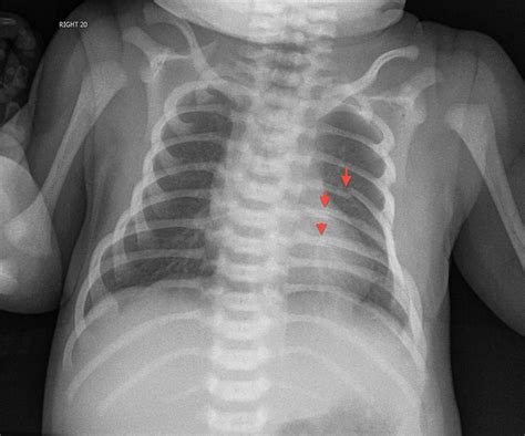 Correct chest compression fraction - leoshell