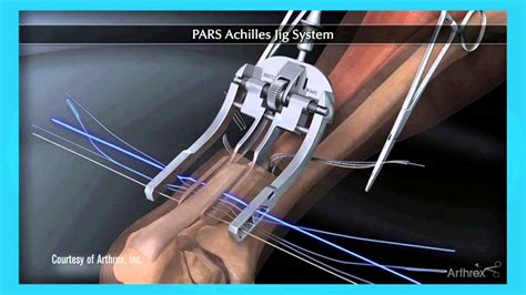 Minimally Invasive Surgery for Achilles Tendon Repair