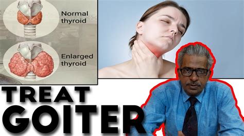 Goiter Treatment in Homeopathy by Dr. P.S. Tiwari - YouTube