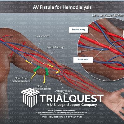 Dialysis Fistula Diagram