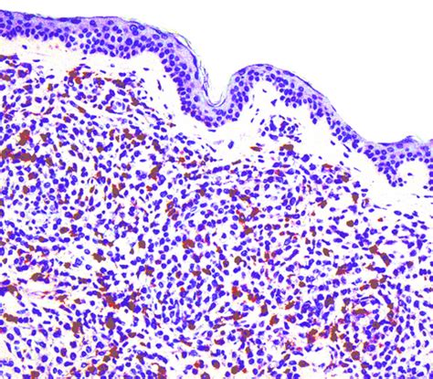 Pathology Outlines - Leukemia cutis