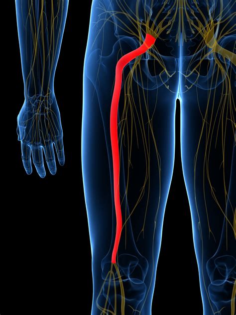 Sciatica: What It Is, Common Causes, and How to Fix It - ARC Health ...