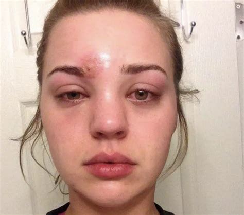 Young Woman Pops A 'Pimple' Above Eye, Then Staph Infection Almost ...