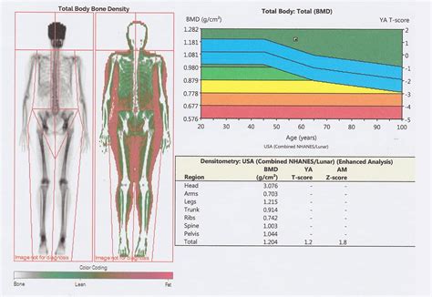 Dexa Scan Chart