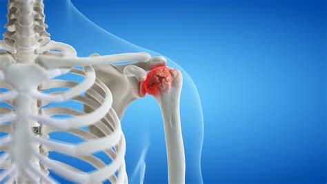 Shoulder Arthritis: What Is It, Symptoms, Treatment, and Prevention ...