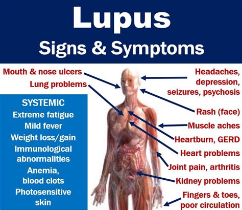 Lupus signs and symptoms with full description of features