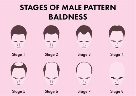 Male Pattern Baldness: Causes, Prevention & The Best Treatments | Blog ...