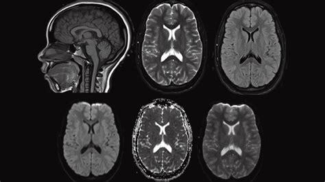 Stroke vs Normal Brain MRI Mri shows 'brain scars' in military ...