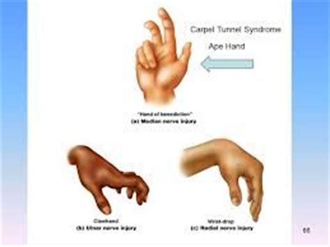 ape hand deformity, wrist drop, claw | Hand therapy, Medical school ...