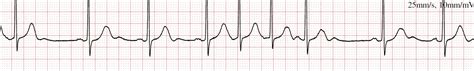 Ectopic Beats Treatment In London | Ectopic Heartbeat | Dr Boon Lim