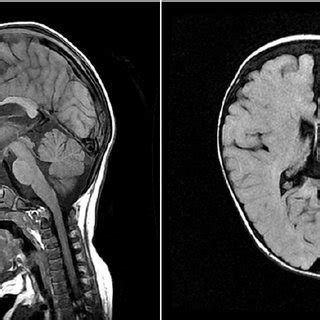 A brain MRI (at 11 months of age) shows diffuse atrophy in both ...