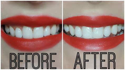 Crest 3d White Strips Before And After Pictures