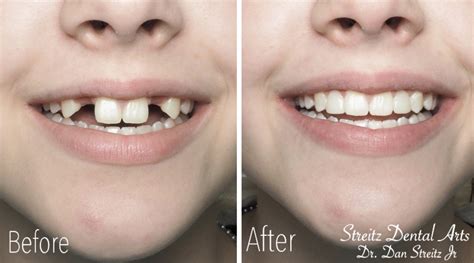 Before and After Photos of Dental Implants and Cosmetic Dentistry