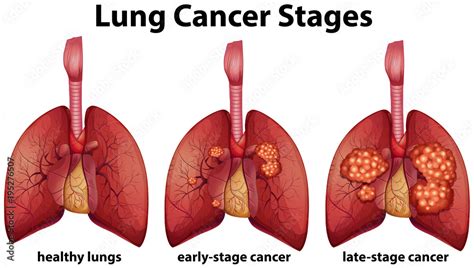 Diagram showing lung cancer stages Stock Vector | Adobe Stock