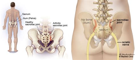 Relief from Sacroiliac Joint Pain — Sobel Spine and Sports