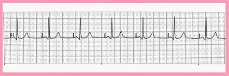 Float Nurse: Various Atrial Paced Rhythms