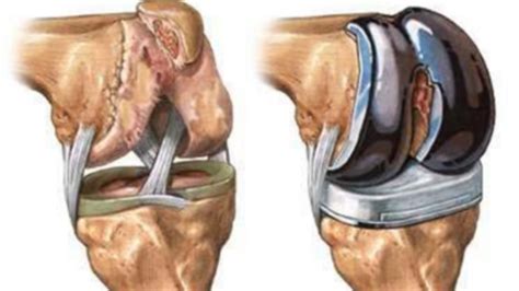 Total Knee Replacement: Don’t skip these steps.