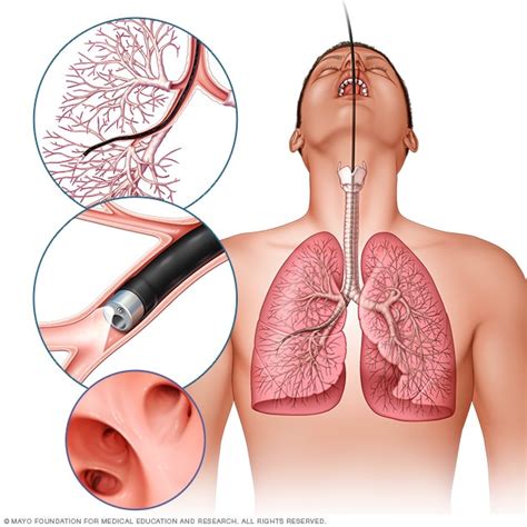 Bronchoscopy - Mayo Clinic