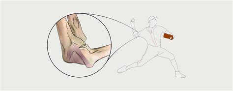 TOMMY JOHN SURGERY (UCL INJURY) - MOTUS Physical Therapy