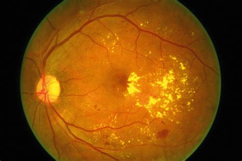 Community Eye Health Journal » Diabetic retinopathy (DR): management ...