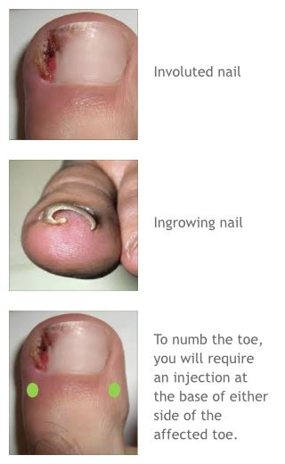 Toenail surgery | Exeter Physio