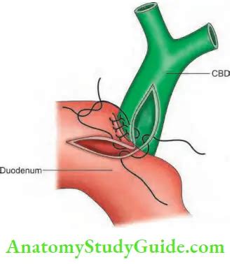 Obstructive Jaundice Treatment - Anatomy Study Guide