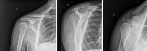 posterior shoulder dislocation xray - ALiEM