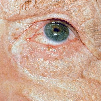 Focus on Eyelid Skin Cancers: Early Detection and Treatment