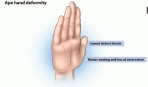 The Upper Extremity Free Trial - Pass The OT