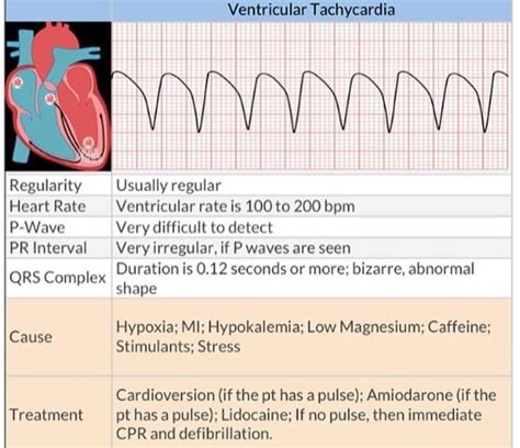 Ventricular Tachycardia | Nursing school essential, Nursing study tips ...