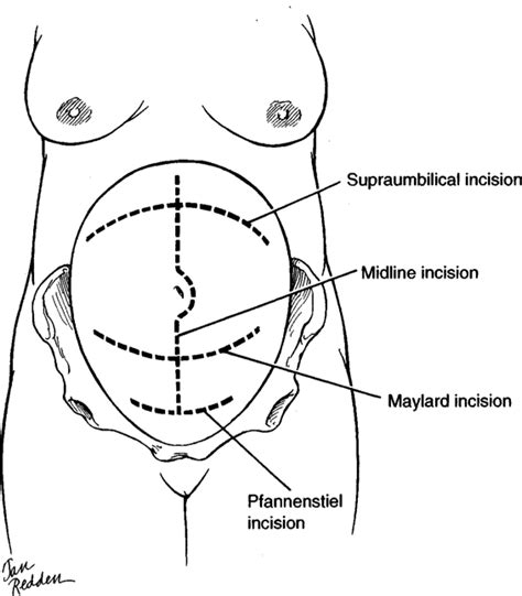 Anatomy, Incisions, and Closures | Obgyn Key