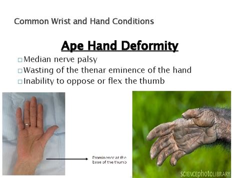 Ulnar Nerve Hand Deformity