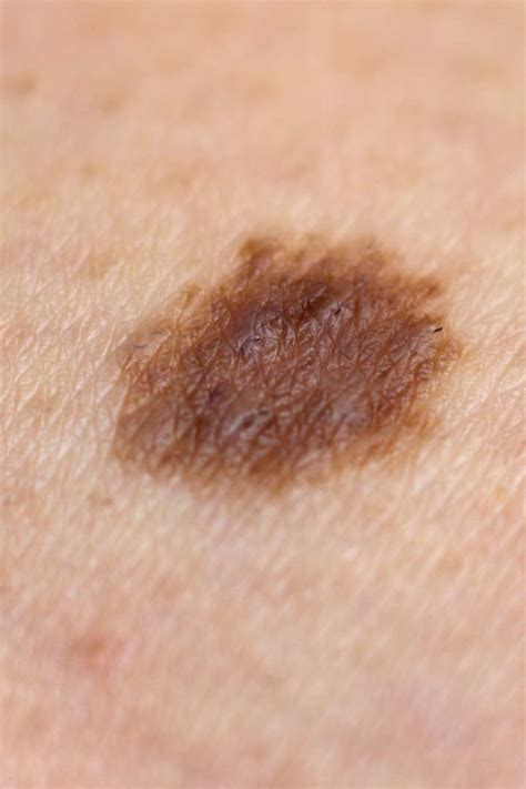 Is it normal for a new mole to appear? Causes and warning signs