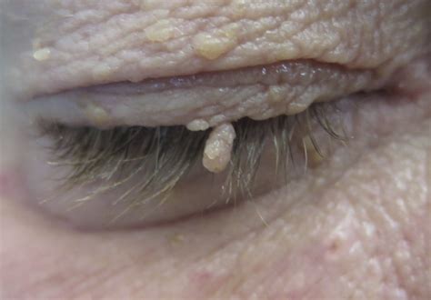 Eyelid Lumps and Bumps (Benign Eyelid Lesions) - Saul Rajak Ophthalmology