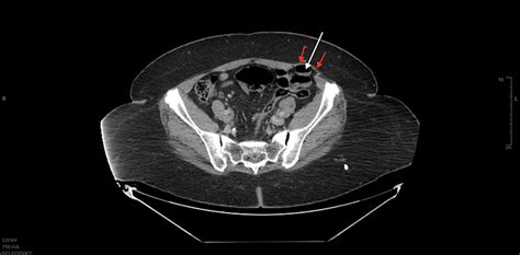 Non-strangulating Spiegel’s Hernia: A Case Report – New Jersey Report