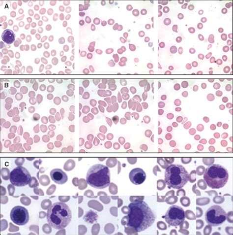 Significance Of Teardrop Cells In Peripheral Blood Smears | The Best ...