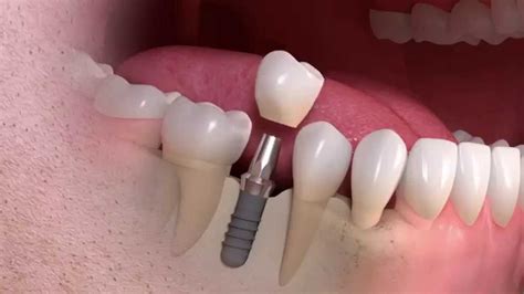 Dental Implants - Diamond Court Dental Practice