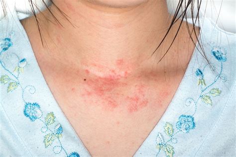 Skin Allergy: Identifying 3 Common Skin Rashes